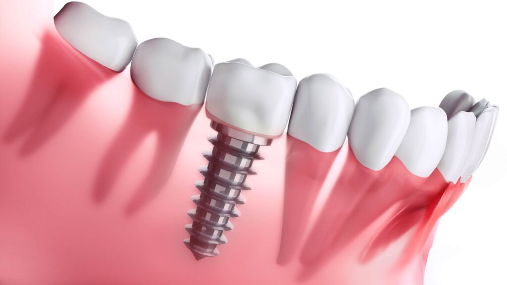 Dental Implants in Miami: Everything You Need to Know Before Getting One