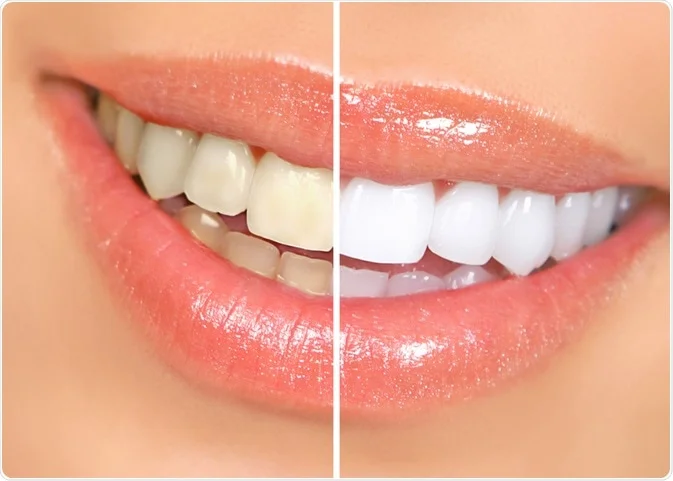 Teeth Whitening in Miami: What to Expect and How to Choose the Right Treatment