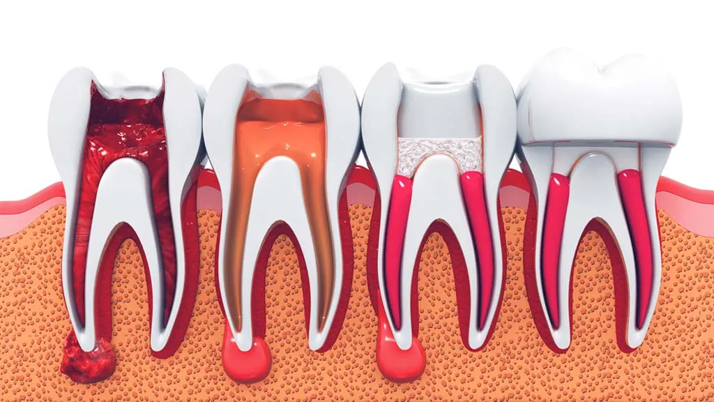 Root Canal Treatment in Miami: What It Really Is and Why It Is Nothing to Fear