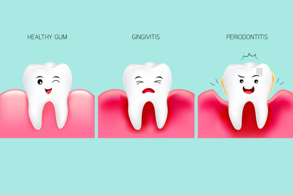 Gum Disease in Miami: Early Signs, Risk Factors, and How to Treat It Before It Gets Worse